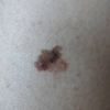 melanom in situ 1