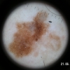 melanom  in situ dermatoscopie